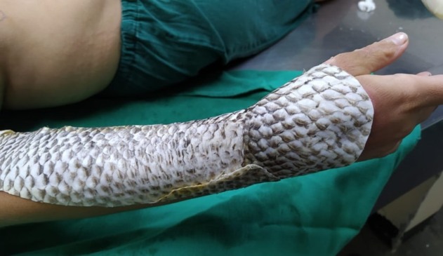 Braço enfaixado com pele de peixe