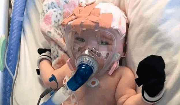 Bebê de 6 meses com respirador