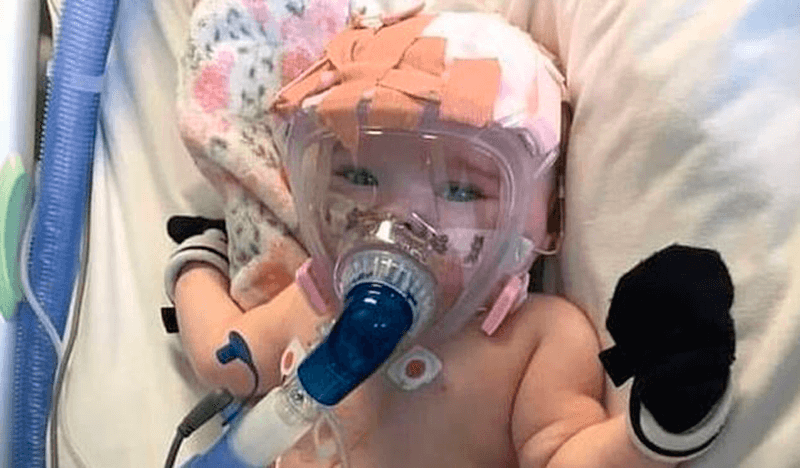 Bebê de 6 meses com respirador