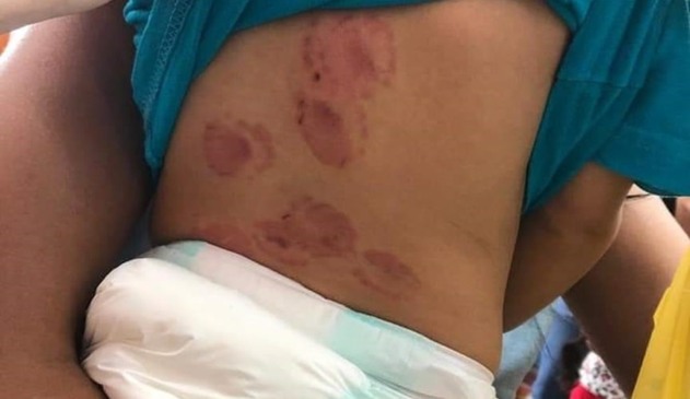 Costas de criança com sinais de mordidas humanas