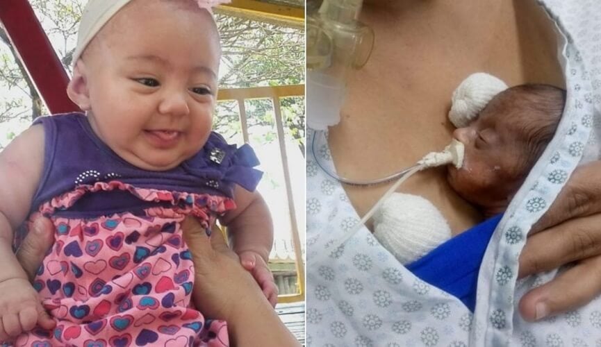 À esquerda, menina de sete meses com vestindo rosa sorrindo; à direita, bebê prematura sendo alimentada por sonda