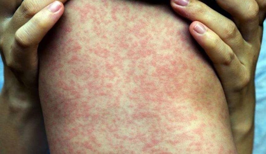 Costas de criança com sarampo