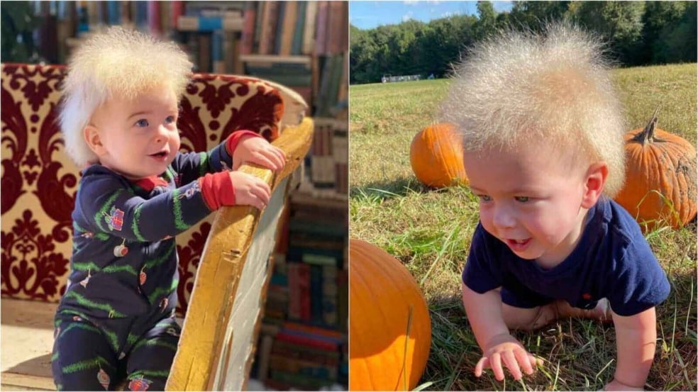 Criança nasce com síndrome do cabelo impenteável