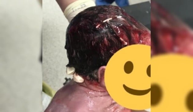 Bebê nasce com DIU enroscado no cabelo e foto viraliza na internet