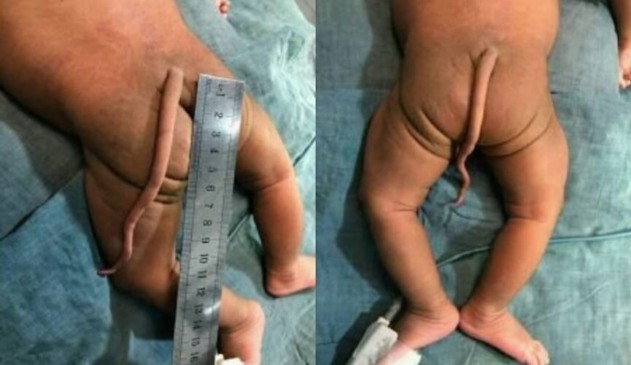 Bebê nasce com cauda de 13 centímetros na Colômbia