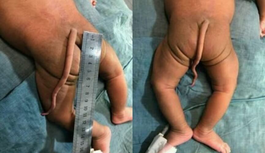 Bebê nasce com cauda de 13 centímetros na Colômbia Bebê nasce com cauda de 13 centímetros na Colômbia