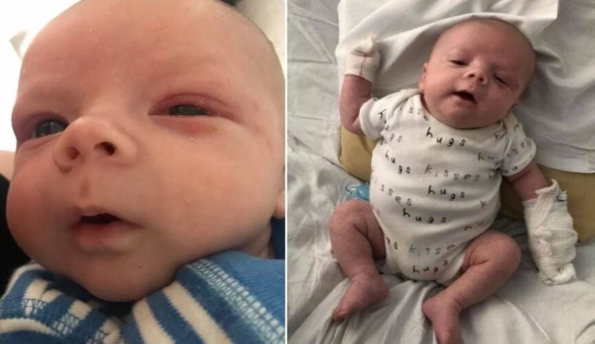 Criança pega herpes após ser beijada