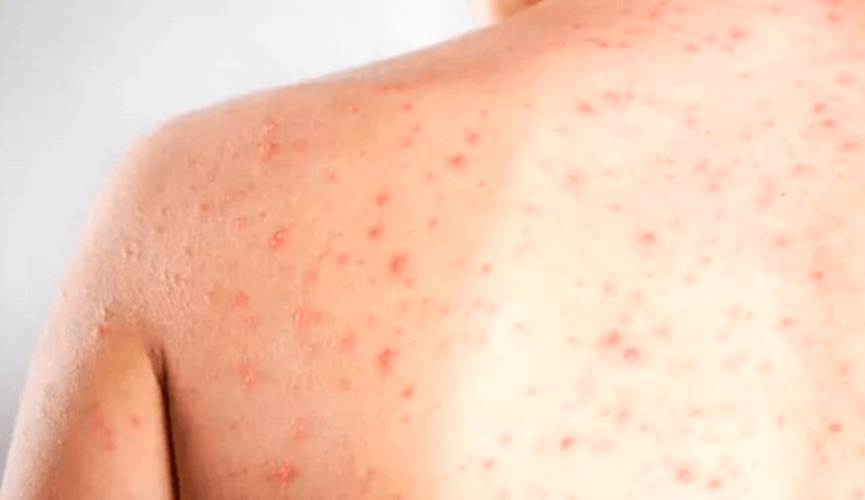 Confirmada primeira morte por sarampo em São Paulo