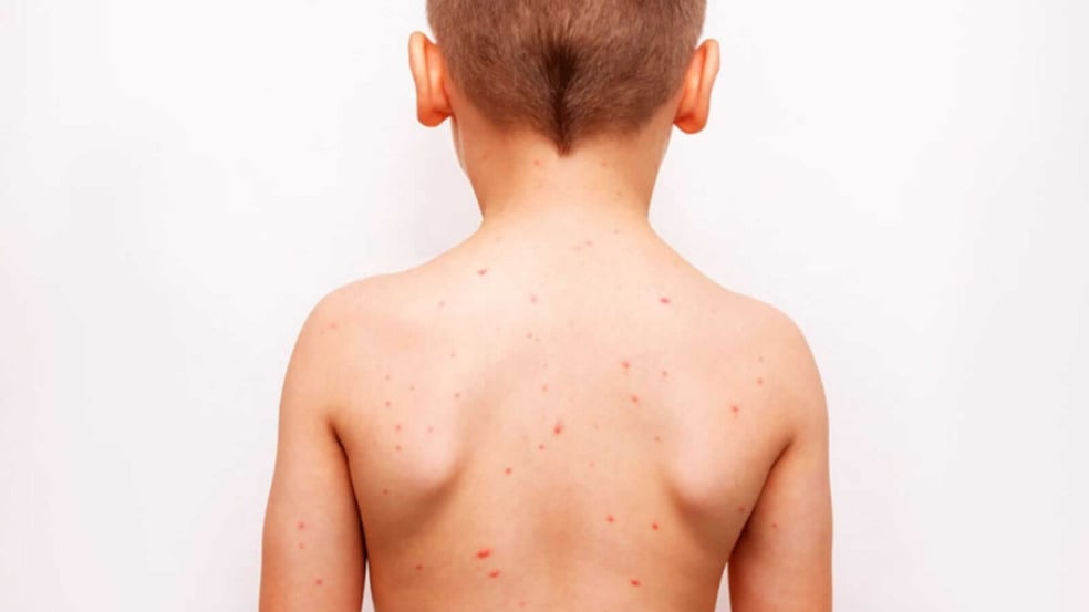 Menino de costas com marcas vermelhas no corpo