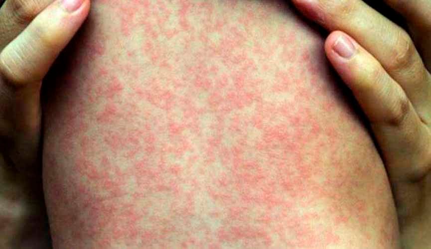 Estado de São Paulo tem mais duas mortes por sarampo confirmadas
