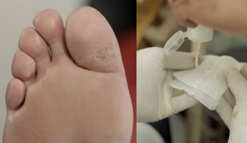 Hidrogel de gengibre criado por brasileiro evita amputação em diabéticos 