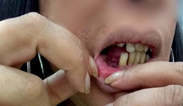 Mulher transgênero perde dente ao ser agredida por marido em Jundiaí