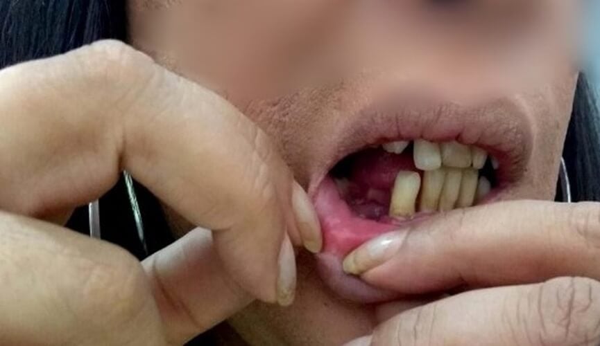 Mulher transgênero perde dente ao ser agredida por marido em Jundiaí
