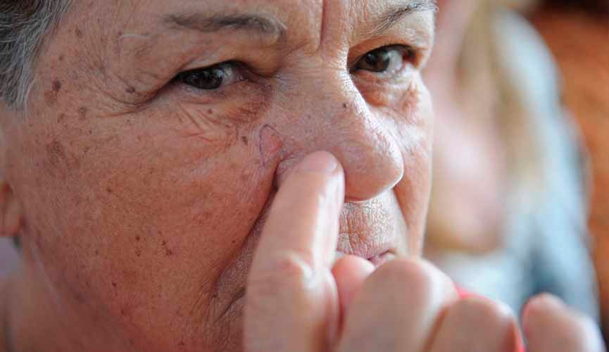 Rosto de idosa em que ela aponta para pinta em seu rosto que está circulada de caneta: a mancha é um câncer de pele