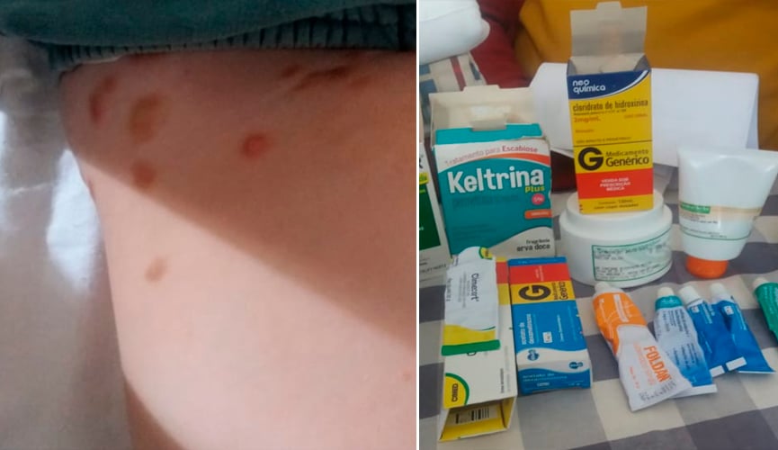 Mãe não consegue exames e remédios para filho com sarna em Itupeva