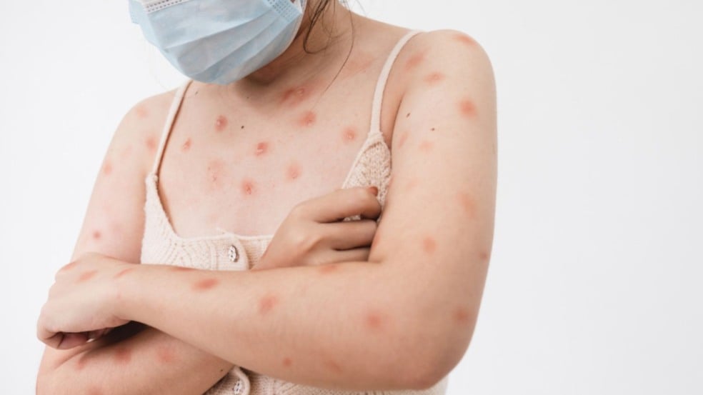 Neste ano, apenas um caso de mpox suspeito foi investigado, mas foi descartado após análise laboratorial