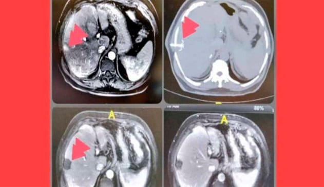 Pesquisadores da USP descobrem tratamento que destrói câncer em 4 minutos