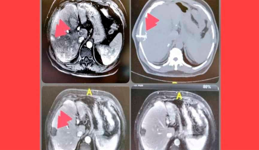 Pesquisadores da USP descobrem tratamento que destrói câncer em 4 minutos