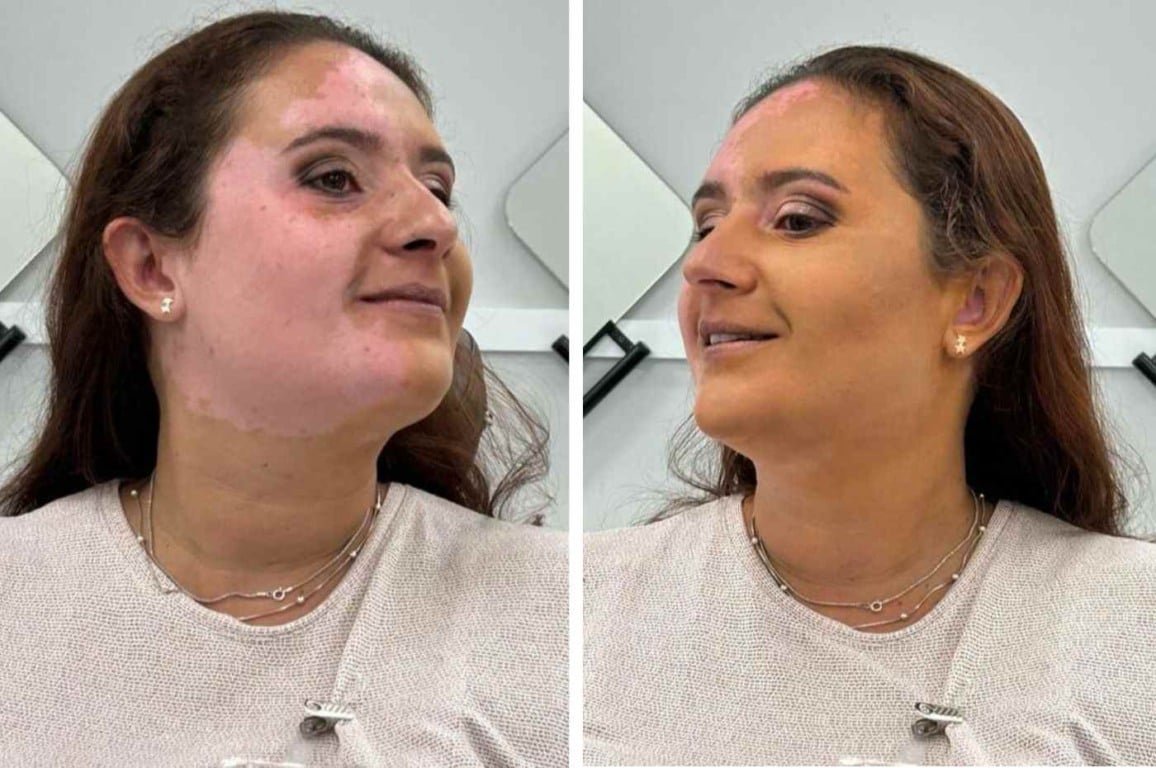 Em curso de maquiagem, aluna do Fundo Social de Jundiaí ressignifica relação com vitiligo