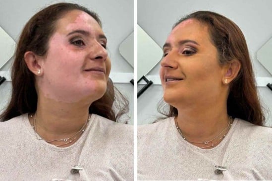 Em curso de maquiagem, aluna do Fundo Social de Jundiaí ressignifica relação com vitiligo