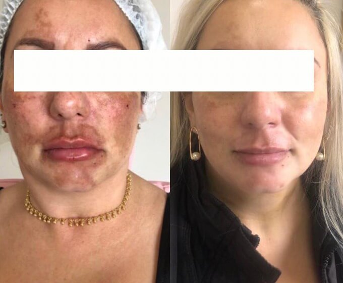 Antes e depois de mulher com melasma