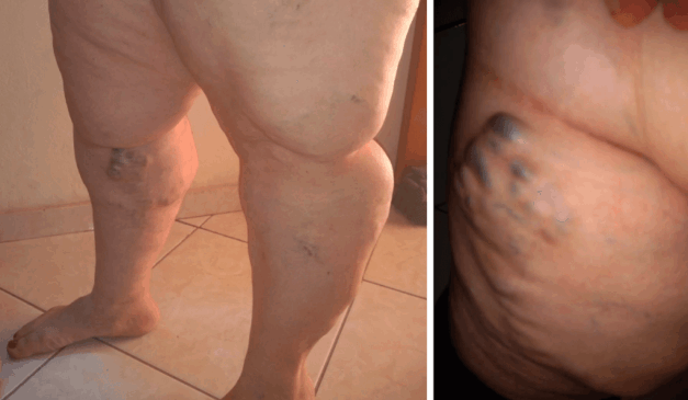 Andreia sofre com varizes e precisa se consultar com um médico vascular. (Foto: Arquivo pessoal)