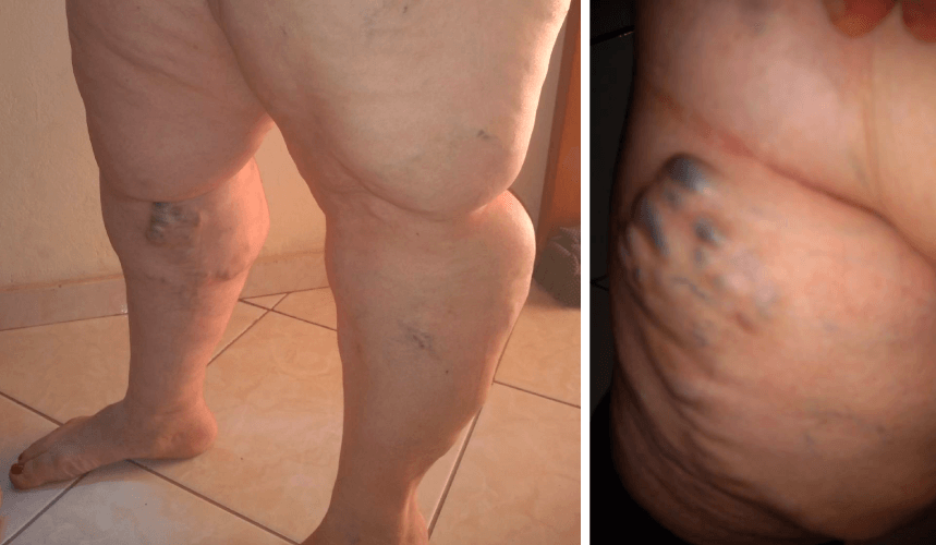 Andreia sofre com varizes e precisa se consultar com um médico vascular. (Foto: Arquivo pessoal)