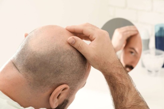 Alopecia androgenética: entenda a calvície e descubra como tratar