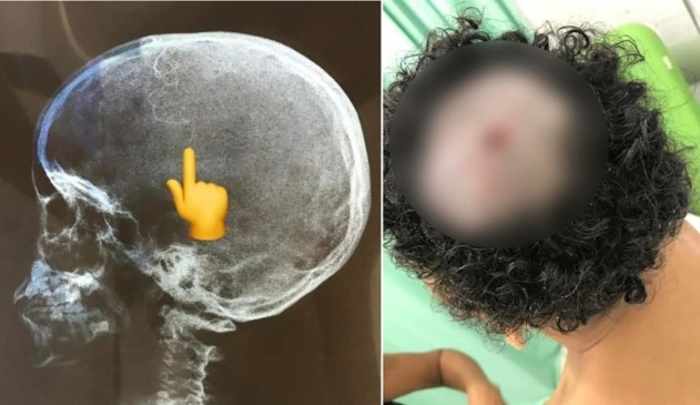 Médicos retiram 40 larvas que estavam comendo cabeça de criança