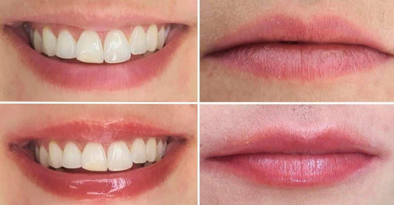 Lip Gloss: especialista explica como procedimento transforma seus lábios Lip Gloss: especialista explica como procedimento transforma seus lábios