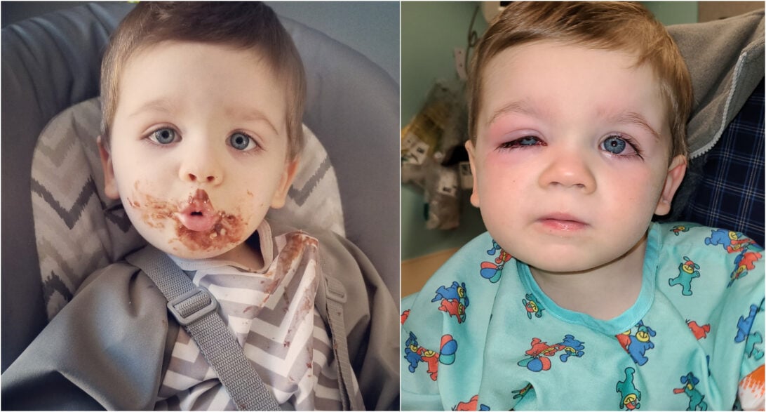 Comparação com fotos da criança antes e depois da bactéria nos olhos.