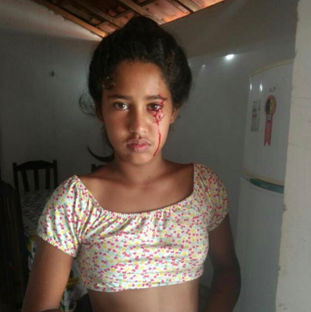 Menina de 12 anos segue em busca de diagnóstico para lágrimas de sangue