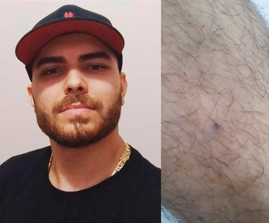 Vendedor picado por cobra em Jundiaí. (Foto: Divulgação)