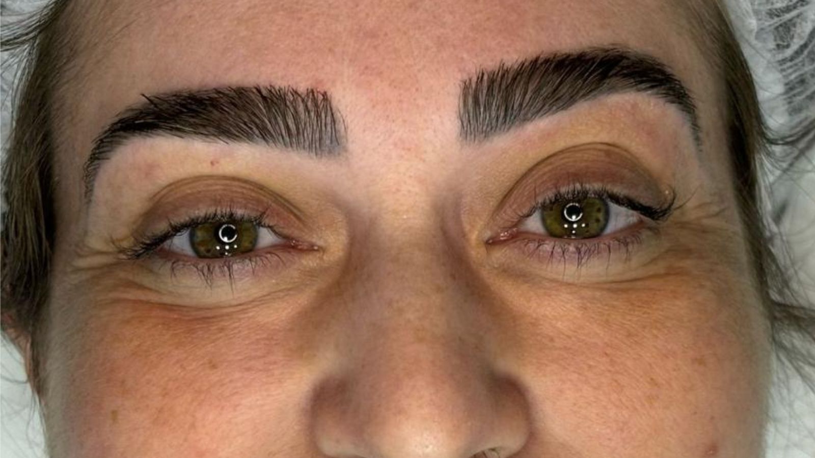 remoção de micropigmentação espaço allure jundiaí