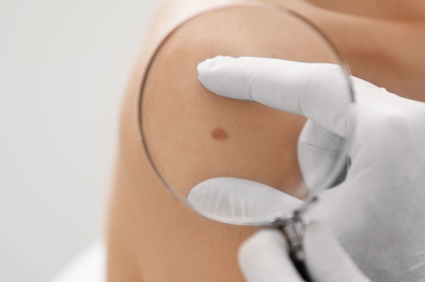 Médico analisando mancha de pontecial câncer de pele