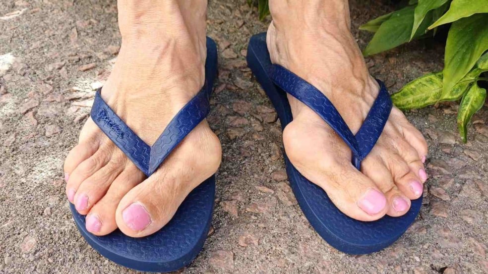 Pés com joanete visível, mostrando a deformidade óssea no dedão, condição conhecida como hálux valgo. Pés com joanete visível, mostrando a deformidade óssea no dedão, condição conhecida como hálux valgo.